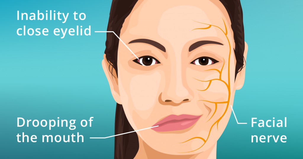bells-palsy