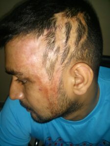 burn-marks-and-baldness-after-an-acid-attack
